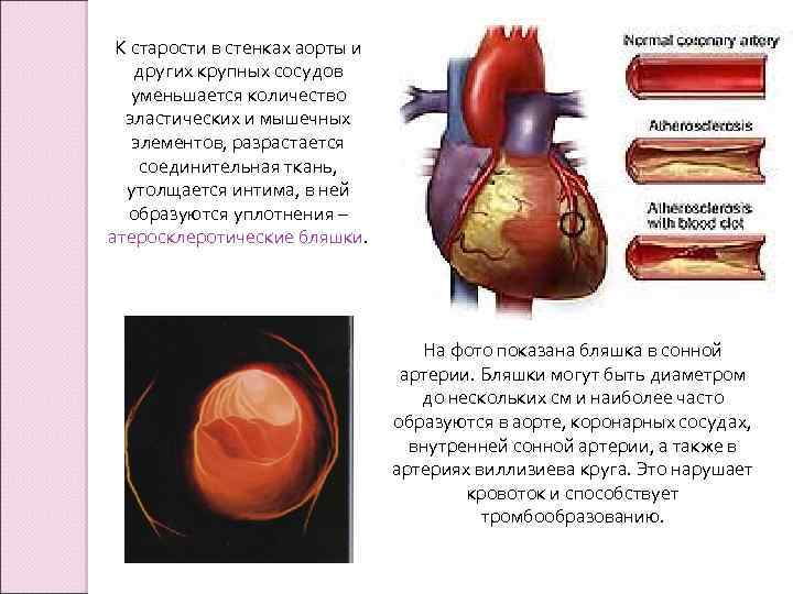 Уплотнение стенок аорты створок аортального клапана