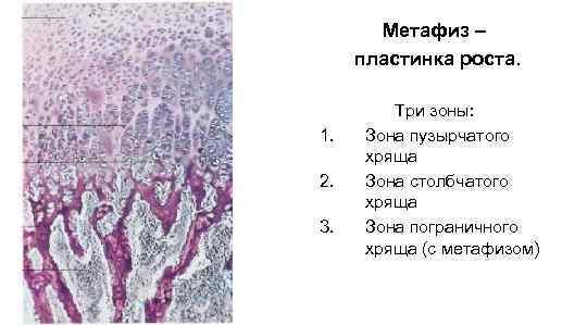 Метафиз – пластинка роста. 1. 2. 3. Три зоны: Зона пузырчатого хряща Зона столбчатого