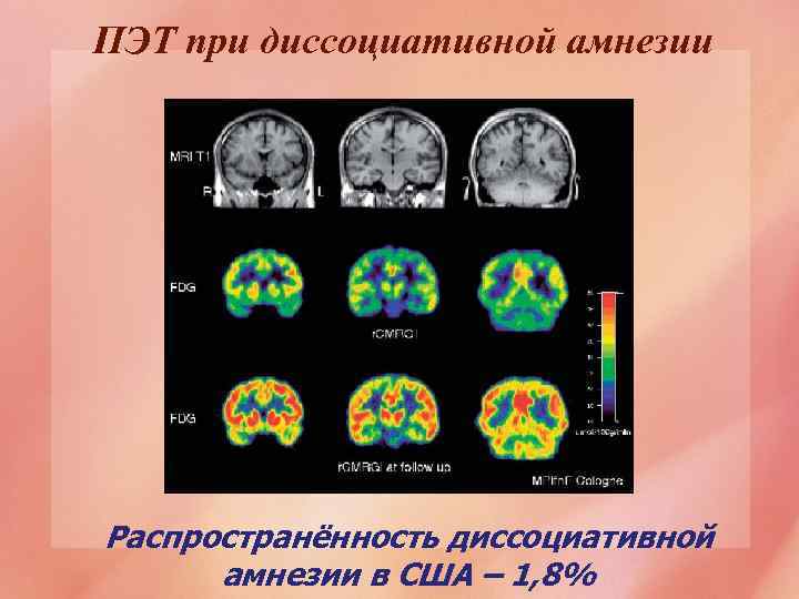 ПЭТ при диссоциативной амнезии Распространённость диссоциативной амнезии в США – 1, 8% 