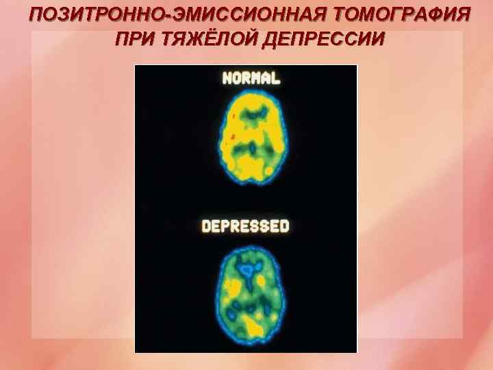 ПОЗИТРОННО-ЭМИССИОННАЯ ТОМОГРАФИЯ ПРИ ТЯЖЁЛОЙ ДЕПРЕССИИ 