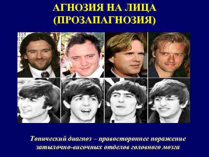 АГНОЗИЯ НА ЛИЦА (ПРОЗАПАГНОЗИЯ) Топический диагноз – правостороннее поражение затылочно-височных отделов головного мозга 
