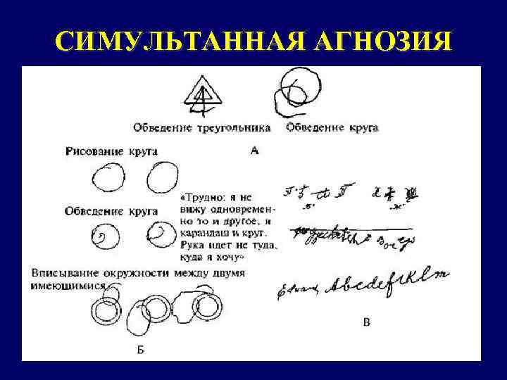 СИМУЛЬТАННАЯ АГНОЗИЯ 