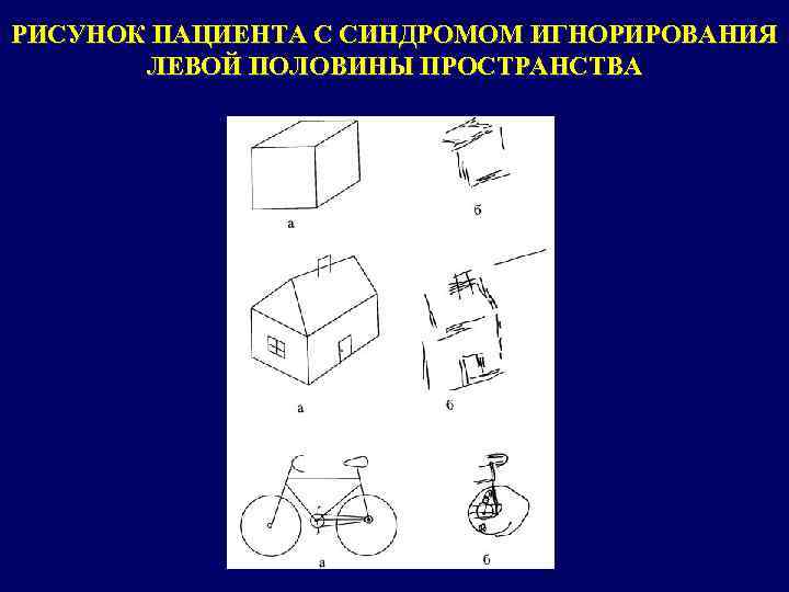 РИСУНОК ПАЦИЕНТА С СИНДРОМОМ ИГНОРИРОВАНИЯ ЛЕВОЙ ПОЛОВИНЫ ПРОСТРАНСТВА 