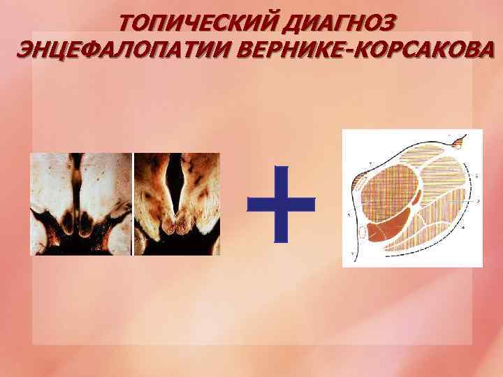 ТОПИЧЕСКИЙ ДИАГНОЗ ЭНЦЕФАЛОПАТИИ ВЕРНИКЕ-КОРСАКОВА 