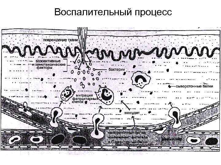 Процесс воспаления