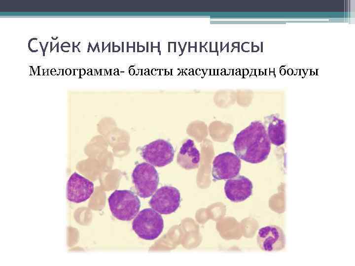 Сүйек миының пункциясы Миелограмма- бласты жасушалардың болуы 