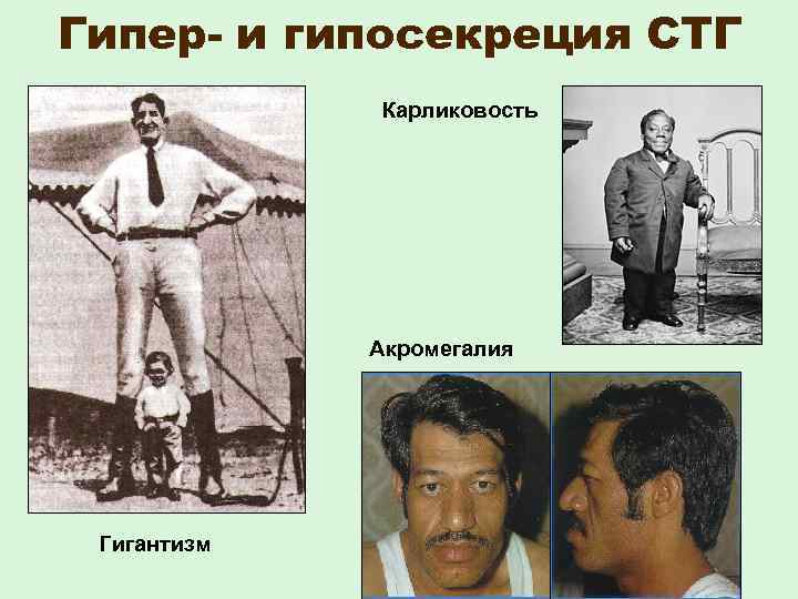 Гипер- и гипосекреция СТГ Карликовость Акромегалия Гигантизм 