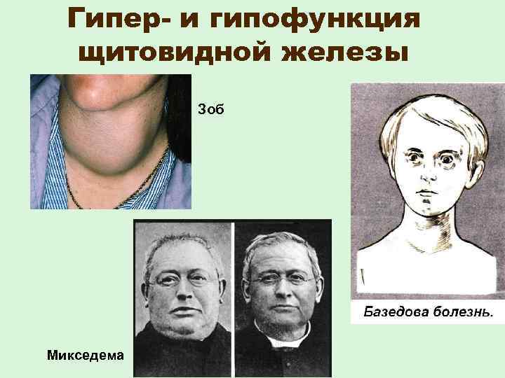  Гипер- и гипофункция щитовидной железы Зоб Микседема 