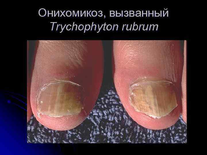 Онихомикоз, вызванный Trychophyton rubrum 