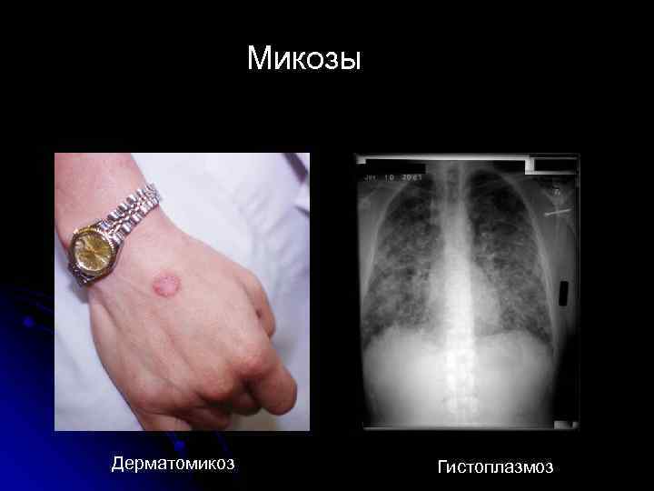 Микозы Дерматомикоз Гистоплазмоз 