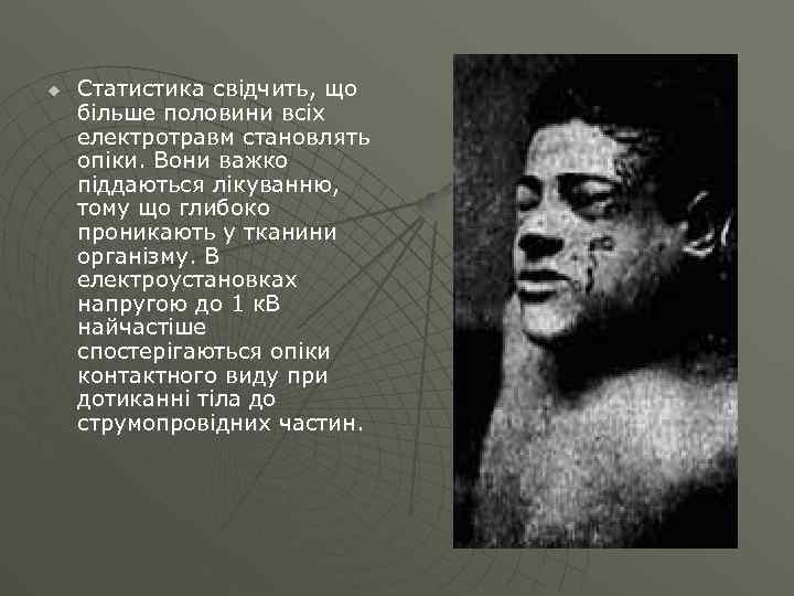 u Статистика свідчить, що більше половини всіх електротравм становлять опіки. Вони важко піддаються лікуванню,