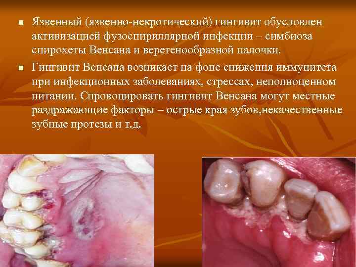 n n Язвенный (язвенно-некротический) гингивит обусловлен активизацией фузоспириллярной инфекции – симбиоза спирохеты Венсана и