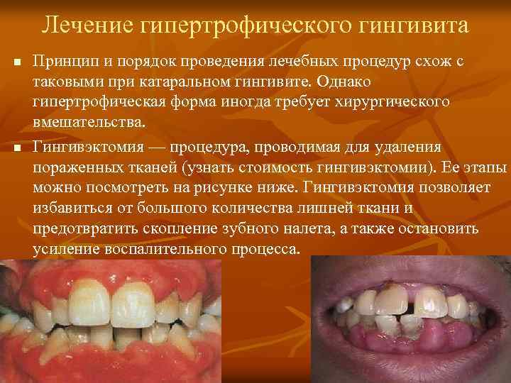 Лечение гипертрофического гингивита n n Принцип и порядок проведения лечебных процедур схож с таковыми