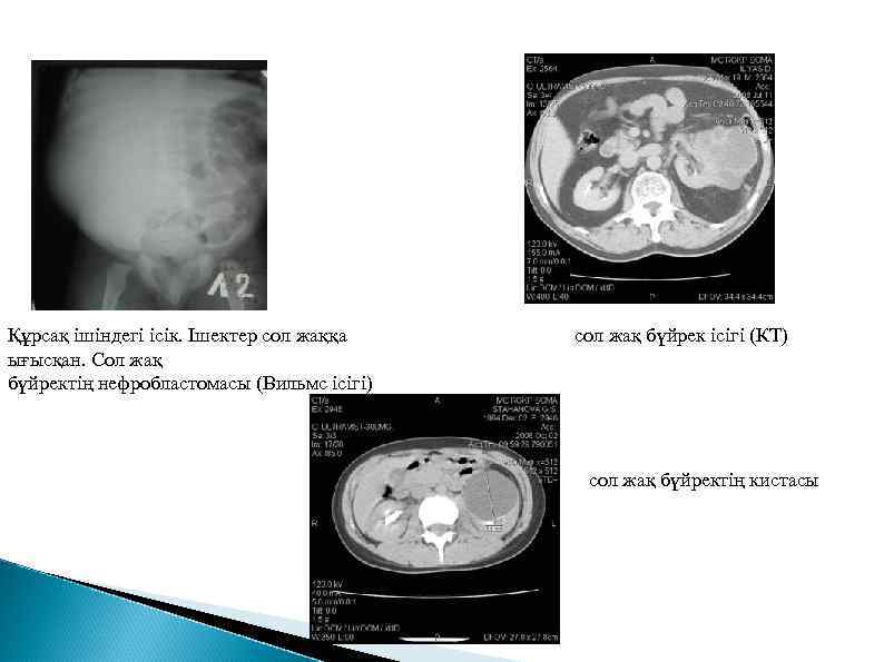 Құрсақ ішіндегі ісік. Ішектер сол жаққа ығысқан. Сол жақ бүйректің нефробластомасы (Вильмс ісігі) сол