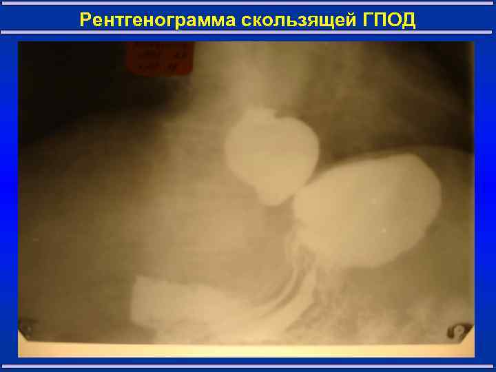 Рентгенограмма скользящей ГПОД 15 