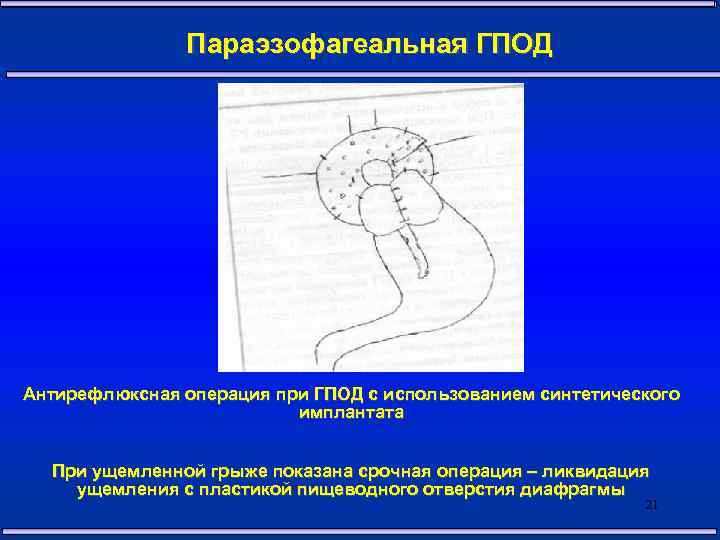  Параэзофагеальная ГПОД Антирефлюксная операция при ГПОД с использованием синтетического имплантата При ущемленной грыже