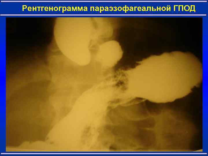 Рентгенограмма параэзофагеальной ГПОД 22 