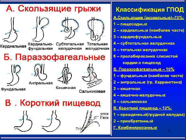  Классификация ГПОД А. Скользящие (аксиальные)– 70%: 1 – пищеводные 2 – кардиальные (наиболее