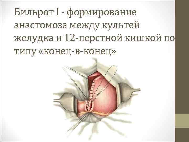 Бильрот I - формирование анастомоза между культей желудка и 12 -перстной кишкой по типу