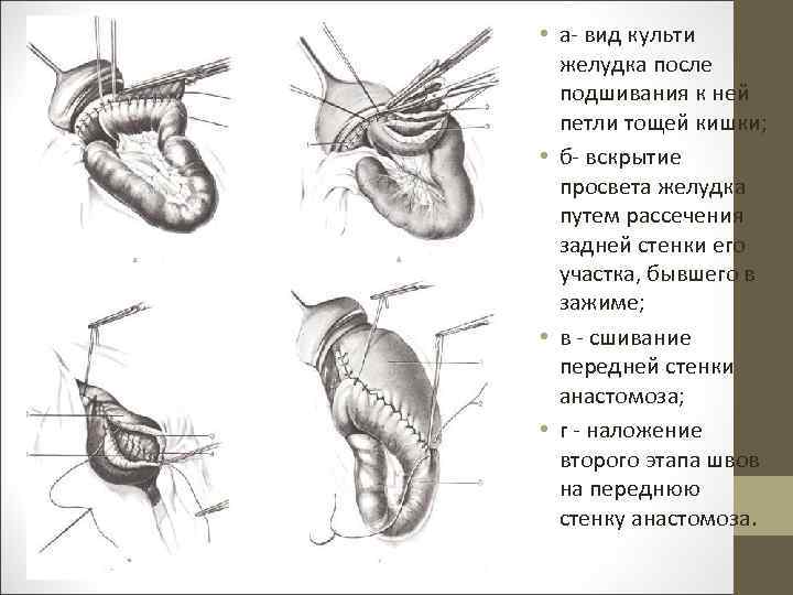  • а- вид культи желудка после подшивания к ней петли тощей кишки; •