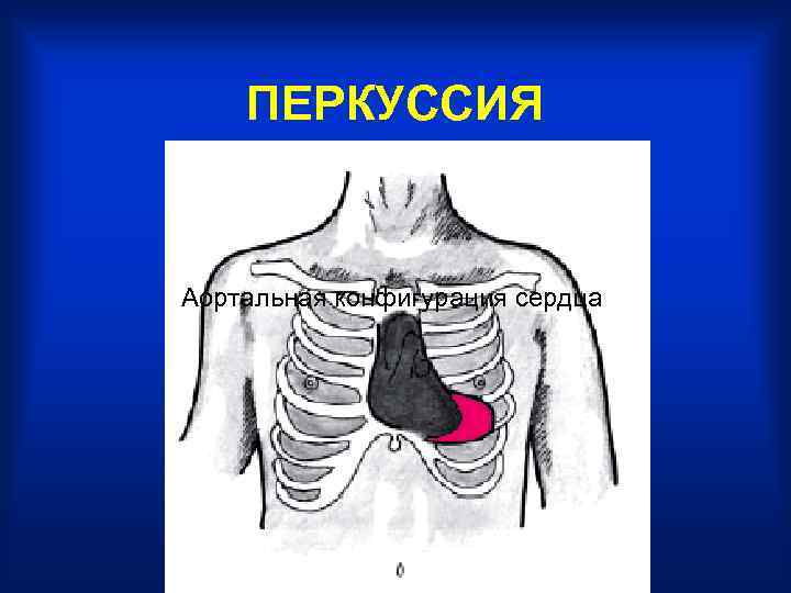 ПЕРКУССИЯ Аортальная конфигурация сердца 