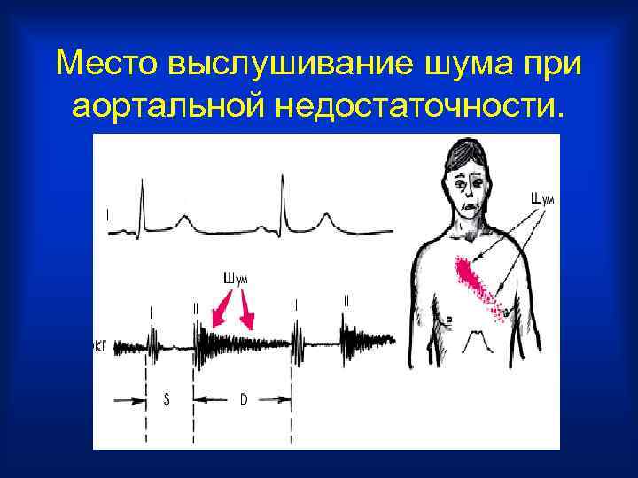 Место выслушивание шума при аортальной недостаточности. 