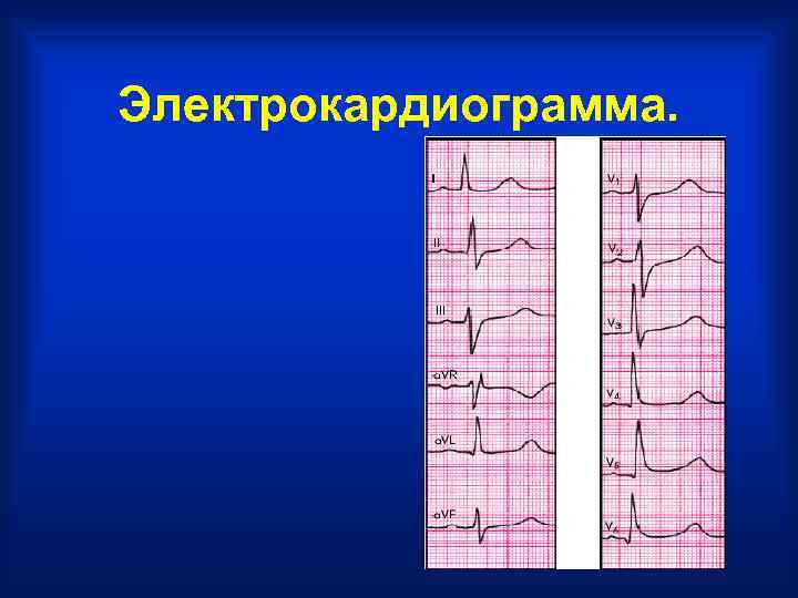 Электрокардиограмма. 