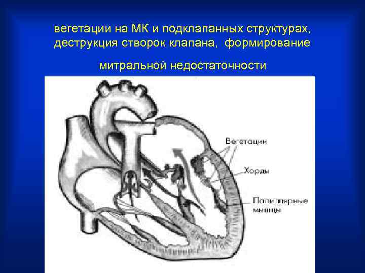 вегетации на МК и подклапанных структурах, деструкция створок клапана, формирование митральной недостаточности 