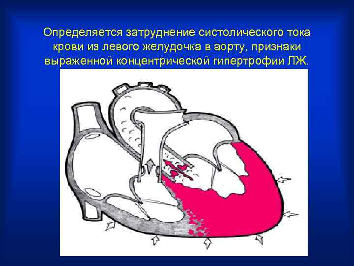 Определяется затруднение систолического тока крови из левого желудочка в аорту, признаки выраженной концентрической гипертрофии