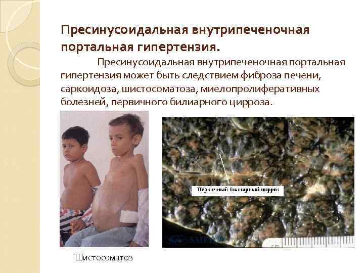 Пресинусоидальная внутрипеченочная портальная гипертензия. Пресинусоидальная внутрипеченочная портальная гипертензия может быть следствием фиброза печени, саркоидоза,