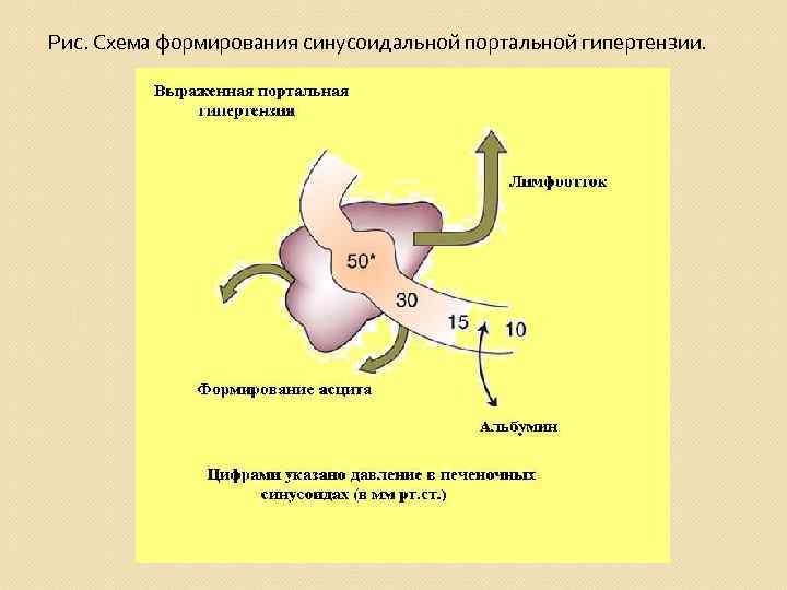 Рис. Схема формирования синусоидальной портальной гипертензии. 
