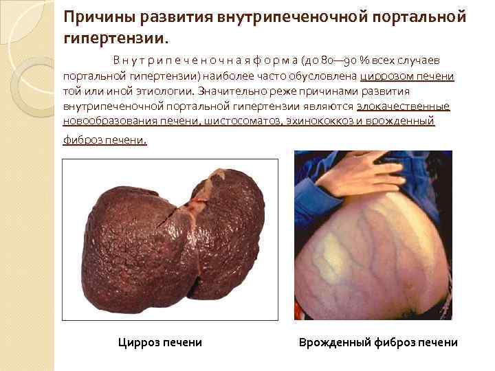 Причины развития внутрипеченочной портальной гипертензии. В н у т р и п е ч