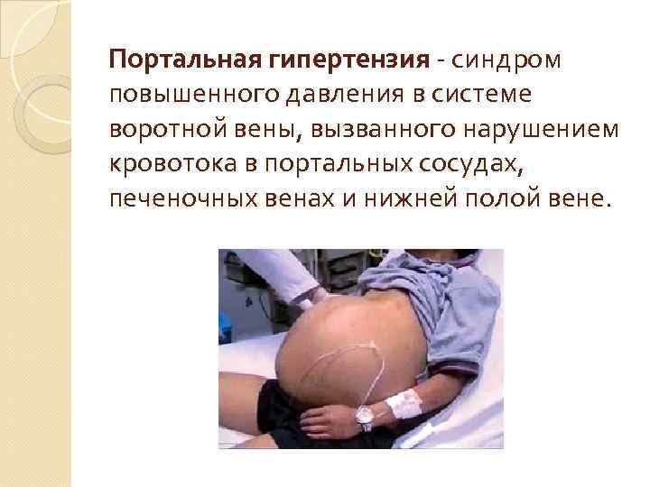 Портальная гипертензия - синдром повышенного давления в системе воротной вены, вызванного нарушением кровотока в