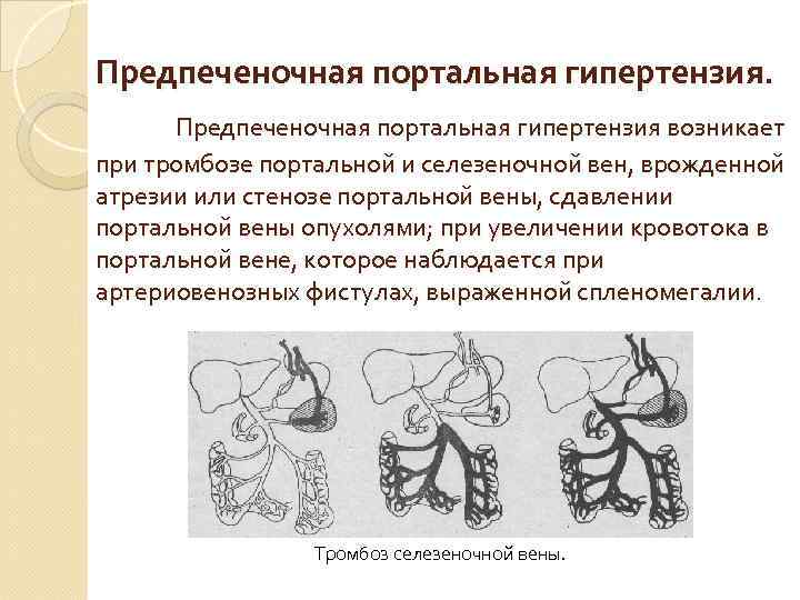Предпеченочная портальная гипертензия возникает при тромбозе портальной и селезеночной вен, врожденной атрезии или стенозе