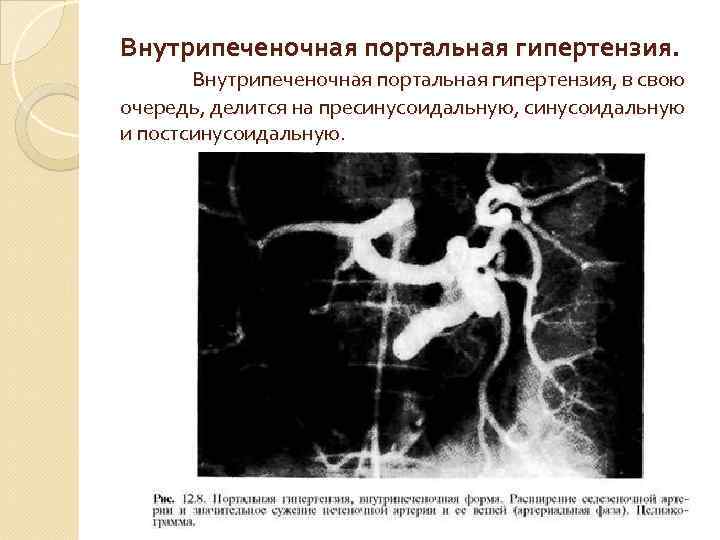 Внутрипеченочная портальная гипертензия, в свою очередь, делится на пресинусоидальную, синусоидальную и постсинусоидальную. 