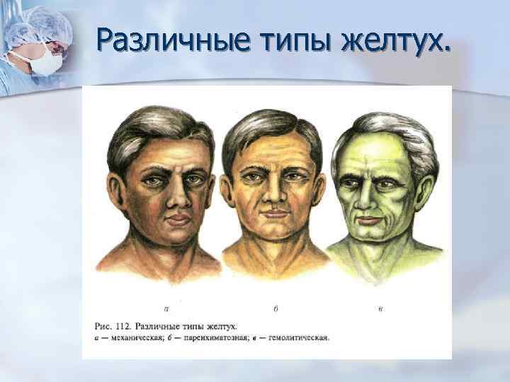 Различные типы желтух. 