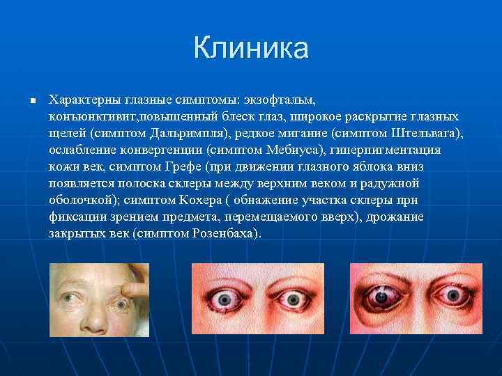 Клиника n Характерны глазные симптомы: экзофтальм, конъюнктивит, повышенный блеск глаз, широкое раскрытие глазных щелей