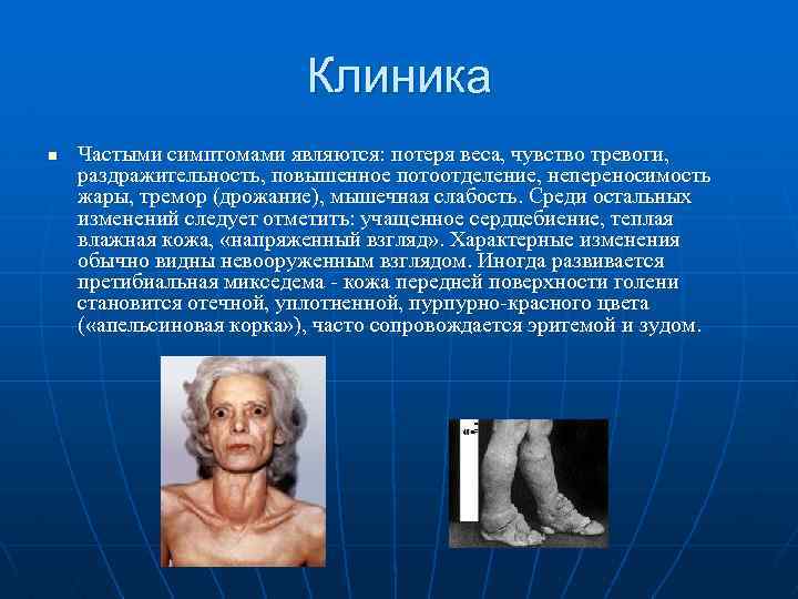 Клиника n Частыми симптомами являются: потеря веса, чувство тревоги, раздражительность, повышенное потоотделение, непереносимость жары,