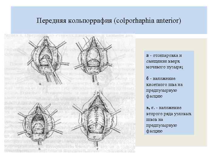 Передняя кольпоррафия (colporhaphia anterior) а - отсепаровка и смещение вверх мочевого пузыря; б -