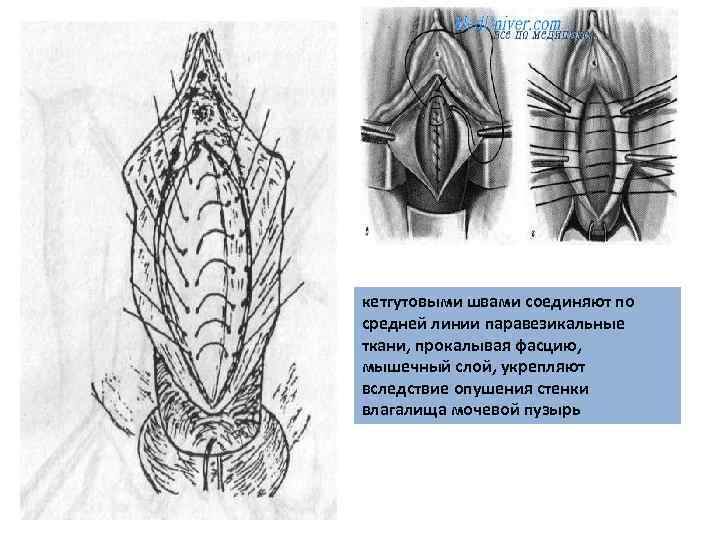 кетгутовыми швами соединяют по средней линии паравезикальные ткани, прокалывая фасцию, мышечный слой, укрепляют вследствие