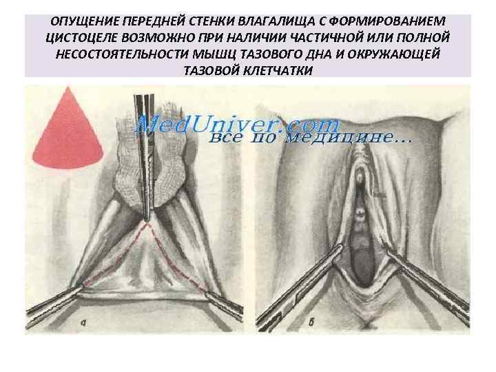 ОПУЩЕНИЕ ПЕРЕДНЕЙ СТЕНКИ ВЛАГАЛИЩА С ФОРМИРОВАНИЕМ ЦИСТОЦЕЛЕ ВОЗМОЖНО ПРИ НАЛИЧИИ ЧАСТИЧНОЙ ИЛИ ПОЛНОЙ НЕСОСТОЯТЕЛЬНОСТИ