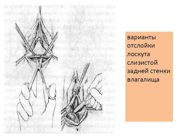 варианты отслойки лоскута слизистой задней стенки влагалища 