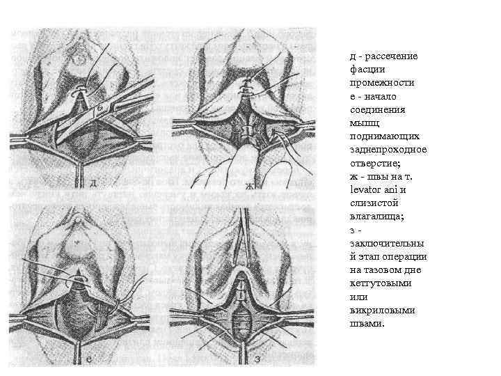 д - рассечение фасции промежности е - начало соединения мышц поднимающих заднепроходное отверстие; ж
