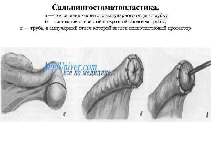 Сальпингостоматопластика. а — рассечение закрытого ампулярного отдела трубы; б — сшивание слизистой и серозной