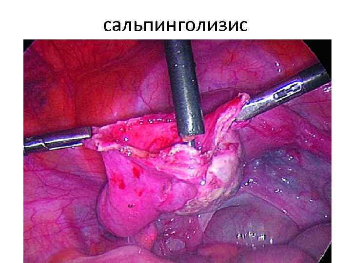 сальпинголизис 