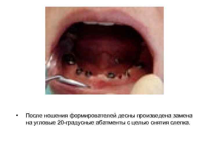  • После ношения формирователей десны произведена замена на угловые 20 -градусные абатменты с