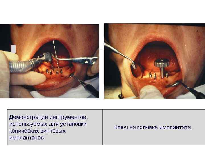 Рис. 5 Демонстрация инструментов, используемых для установки конических винтовых имплантатов Ключ на головке имплантата.