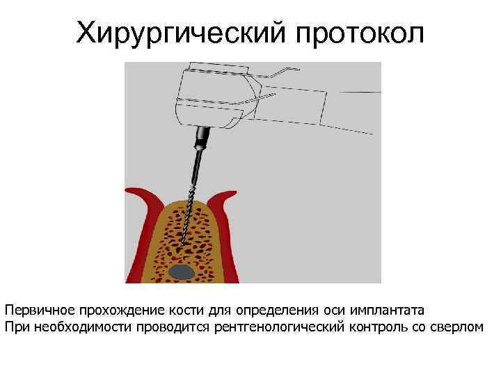 Хирургический протокол Первичное прохождение кости для определения оси имплантата При необходимости проводится рентгенологический контроль