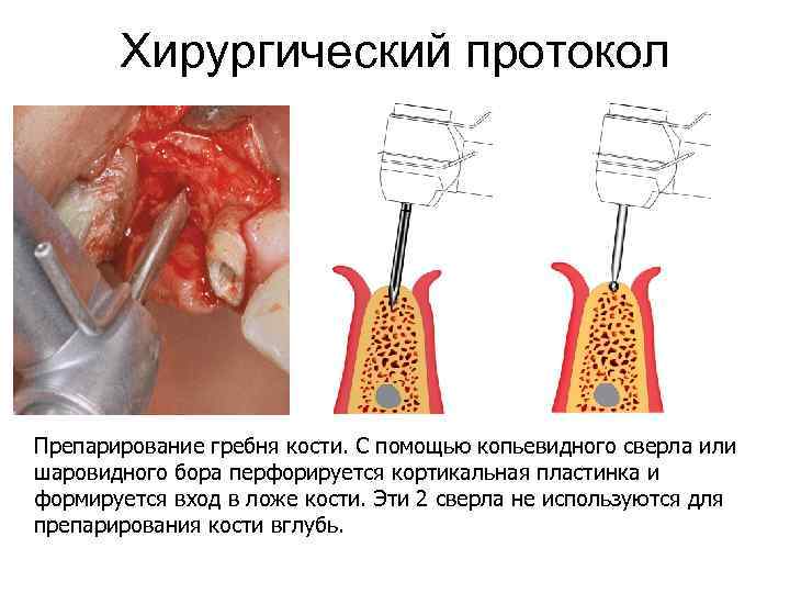 Хирургический протокол Препарирование гребня кости. С помощью копьевидного сверла или шаровидного бора перфорируется кортикальная