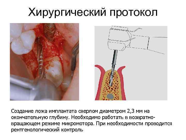 Хирургический протокол Создание ложа имплантата сверлом диаметром 2, 3 мм на окончательную глубину. Необходимо